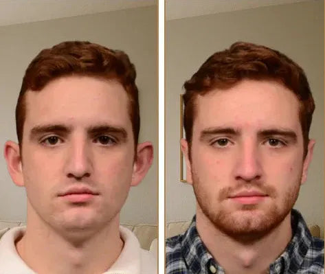 Aurix – Ear Corrector Clip